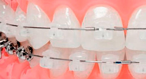 valor ortodoncia tarifas en Bogota